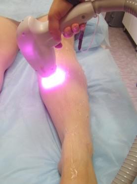 Лазерная эпиляция ног