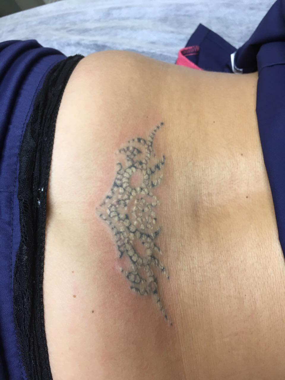 Удаление татуировок лазером, фото сразу после процедуры