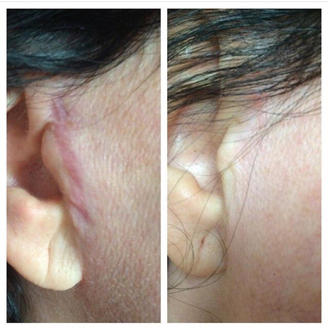 Как убрать рубцы после операций на лице: лечение послеоперационных шрамов, средства и косметология